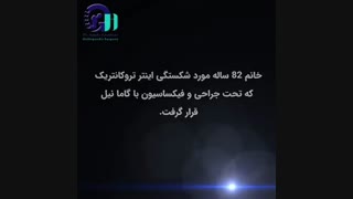 شکستگی اینتر تروکانتریک  تحت جراحی و فیکساسیون با گاما