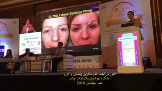 آموزش لیفت آندوسکوپی پیشانی و ابرو | پروفسور کشکولی | کنگره جراحان پلاستیک چشم در هند