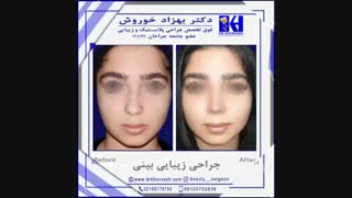 نمونه کار جراحی زیبایی بینی دکتر خوروش