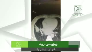 بیوپسی ریه
