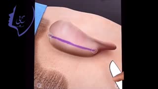 انیمیشن جراحی اتوپلاستی