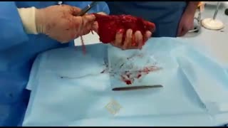 عمل برداشت کلیه وحالب از طریق تکنیک لاپاراسکوپی