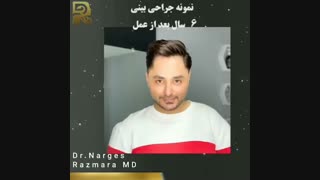 جراحی بینی مردانه بعد از شش سال