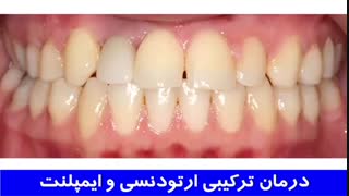 درمان ترکیبی ارتودنسی و ایمپلنت | دکتر احسان مهریزی