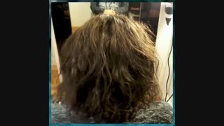 پروتز مو  چیست 09198858620