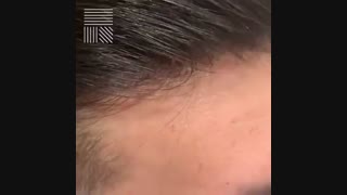 پروتز مو آلمانی فیکس 09198858620