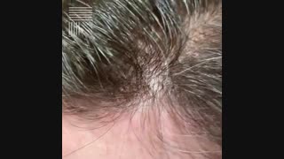 پروتز مو عوارض دارد  09198858620