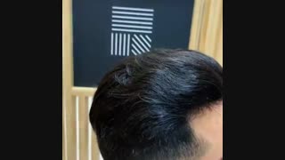 خرید پروتز مو مردانه  09198858620