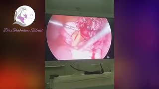 جراحی لاپاراسکوپی میومکتومی