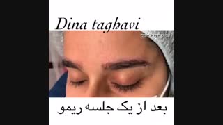 ریموو تاتو ابرو
