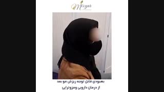 درمان ریزش مو با دارو و مزوتراپی مو