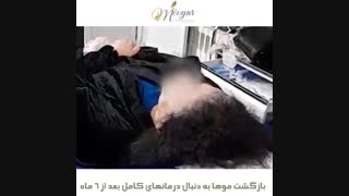 درمان ریزش مو