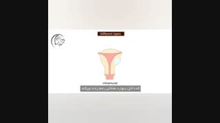 تعریف فیبروم و میوم رحمی