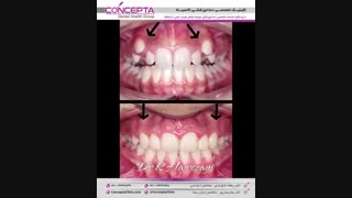 درمان ارتودنسی ثابت دو فک بدون کشیدن دندان | کلینیک تخصصی دندانپزشکی کانسپتا