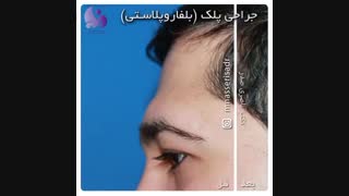 فیلم عمل جراحی پلک در مشهد