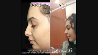 پنج روز بعد از جراحی زیبایی بینی توسط دکتر امید ابراهیمی بهترین جراح بینی